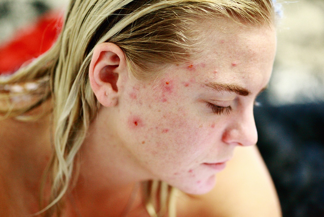 acne scars