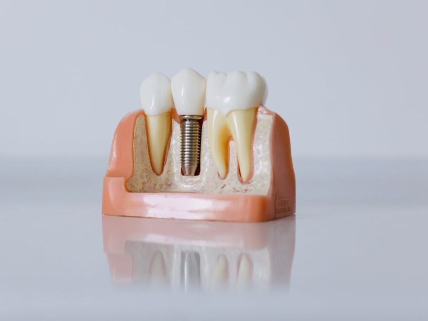 Dental Implants